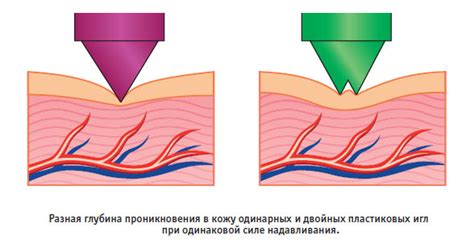 Эффективность тибетского аппликатора