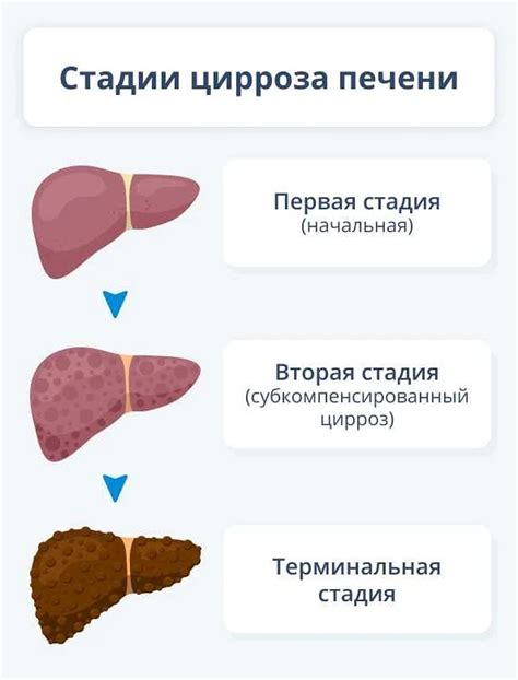 Эффективные домашние методы диагностики цирроза печени