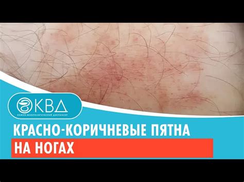 Эффективные методы лечения коричневых пятен на икрах ног