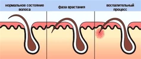 Эффективные методы удаления вросших волосков на ногах