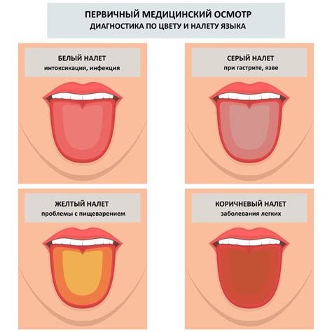 Эффективные способы удаления налета с языка