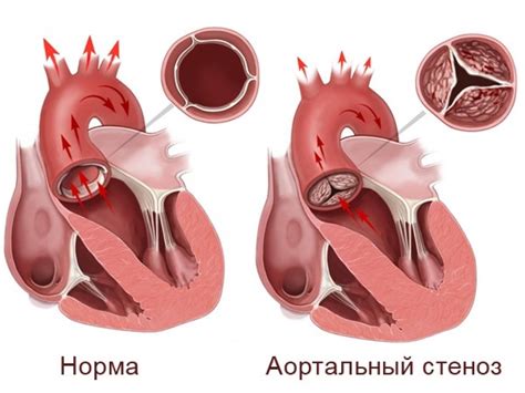  Диагностика стеноза 