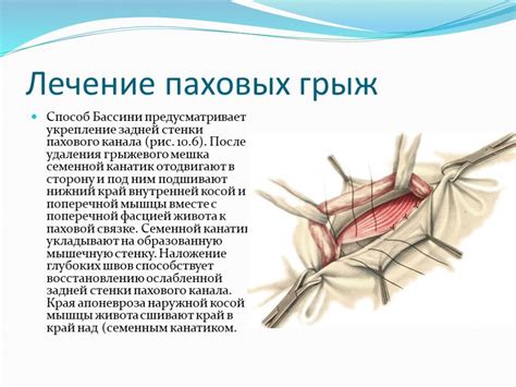  Правильное питание при паховой грыже 