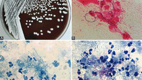 Nocardia spp и его осложнения