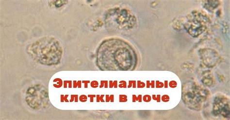 Squamous эпителиальные клетки в моче